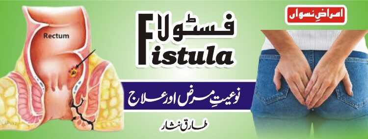 فسٹولا نوعیت مرض اورعلاج